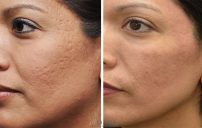acne scar removal L1
