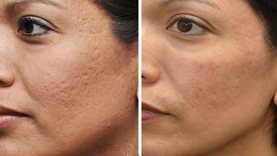 acne scar removal L1