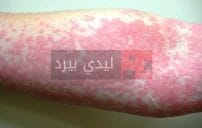 urticaria