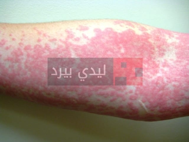 urticaria