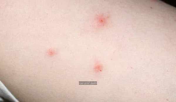 علاج قرصة بق الفراش