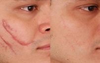 Home Remedies For Scar Removal