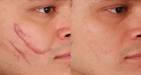 Home Remedies For Scar Removal