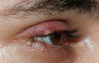 Stye02