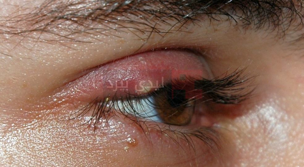 Stye02