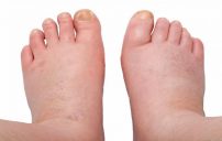 Swollen Ankles Legs and Feet