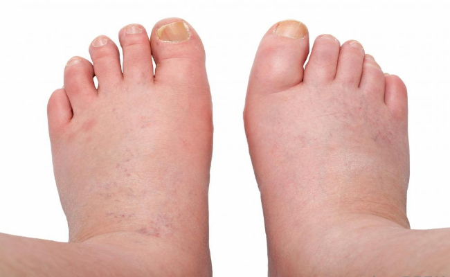 Swollen Ankles Legs and Feet