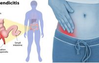 appendicitis