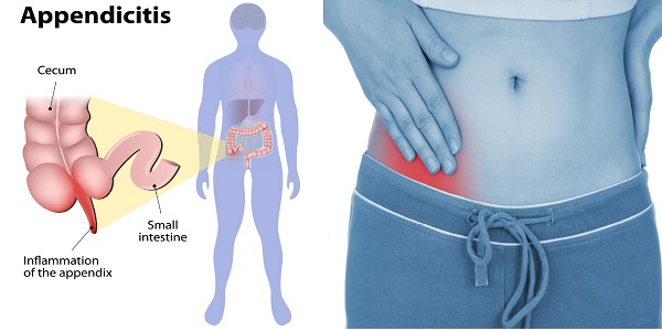 appendicitis