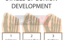 bunion development 600x567 e1464285160387