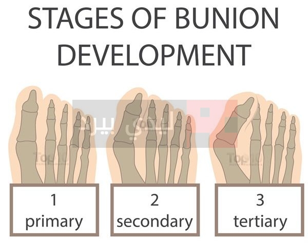 bunion development 600x567 e1464285160387