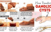 ganglion cysts 600x413 e1464282820471