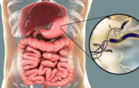 علاج جرثومة المعدة متعب