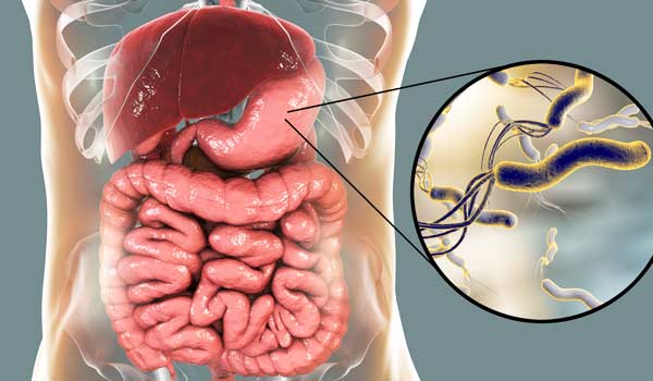 علاج جرثومة المعدة متعب