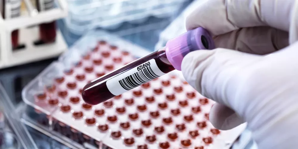 تحليل الكوليسترول الكامل: قراءة النتائج وفهم LDL وHDL بسهولة 1 4e4de5705c1590dce367f3c5067acbbc